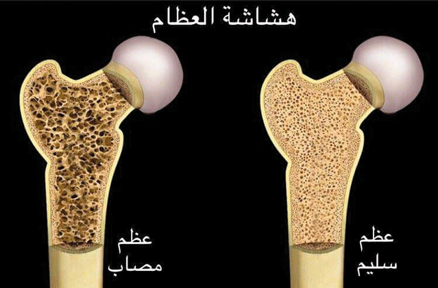 هل يشفى مريض هشاشة العظام؟