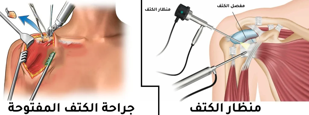 تكلفة عملية قطع وتر الكتف