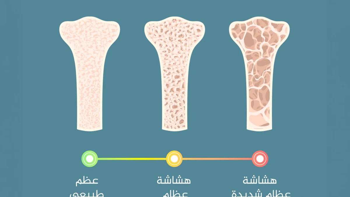 هل يشفى مريض هشاشة العظام؟