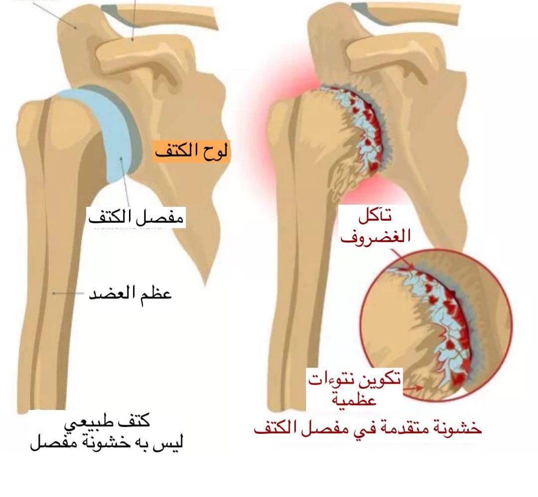  أعراض الخشونه في الكتف