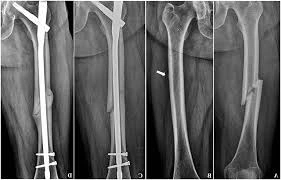المسمار النخاعي