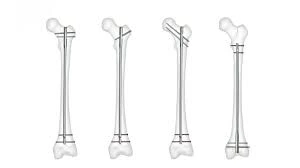 المسمار النخاعي