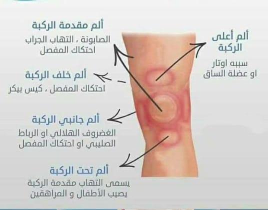أسباب خشونة الركبة