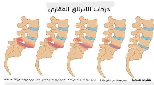 الانزلاق الغضروفي