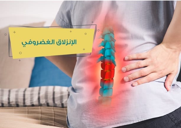 ما هو الانزلاق الغضروفي؟ 
