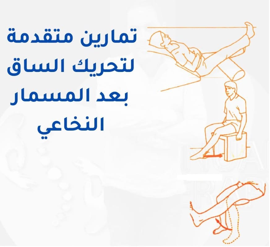 تمارين مسمار نخاعي