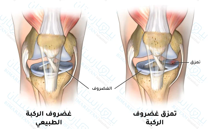 تمزق الغضروف الهلالي بكافة تفاصيله