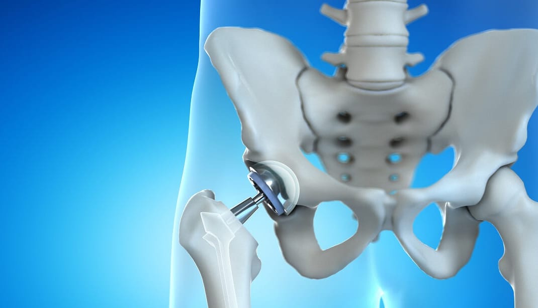 مخاطر عملية تغيير مفصل الحوض 2025