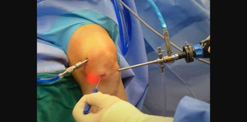 متى استطيع المشي بعد عملية غضروف الركبة؟