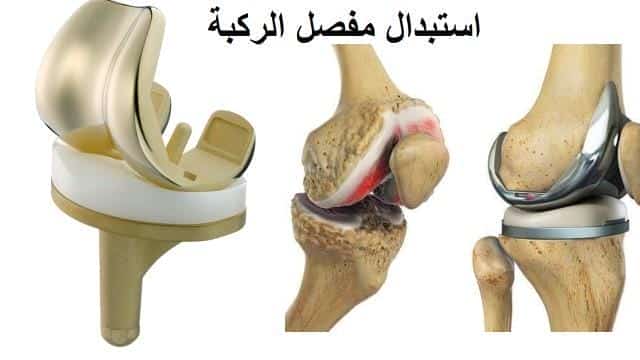 أفضل دكتور تغيير مفصل الركبة في مصر 2025