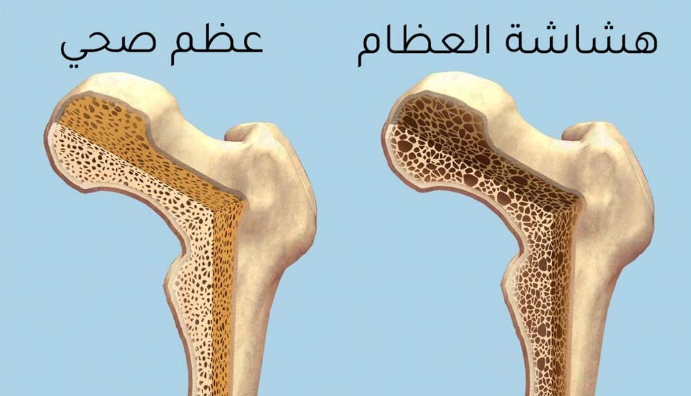 كيف يمكنك معالجة هشاشة العظام بشكل شامل وفعال؟