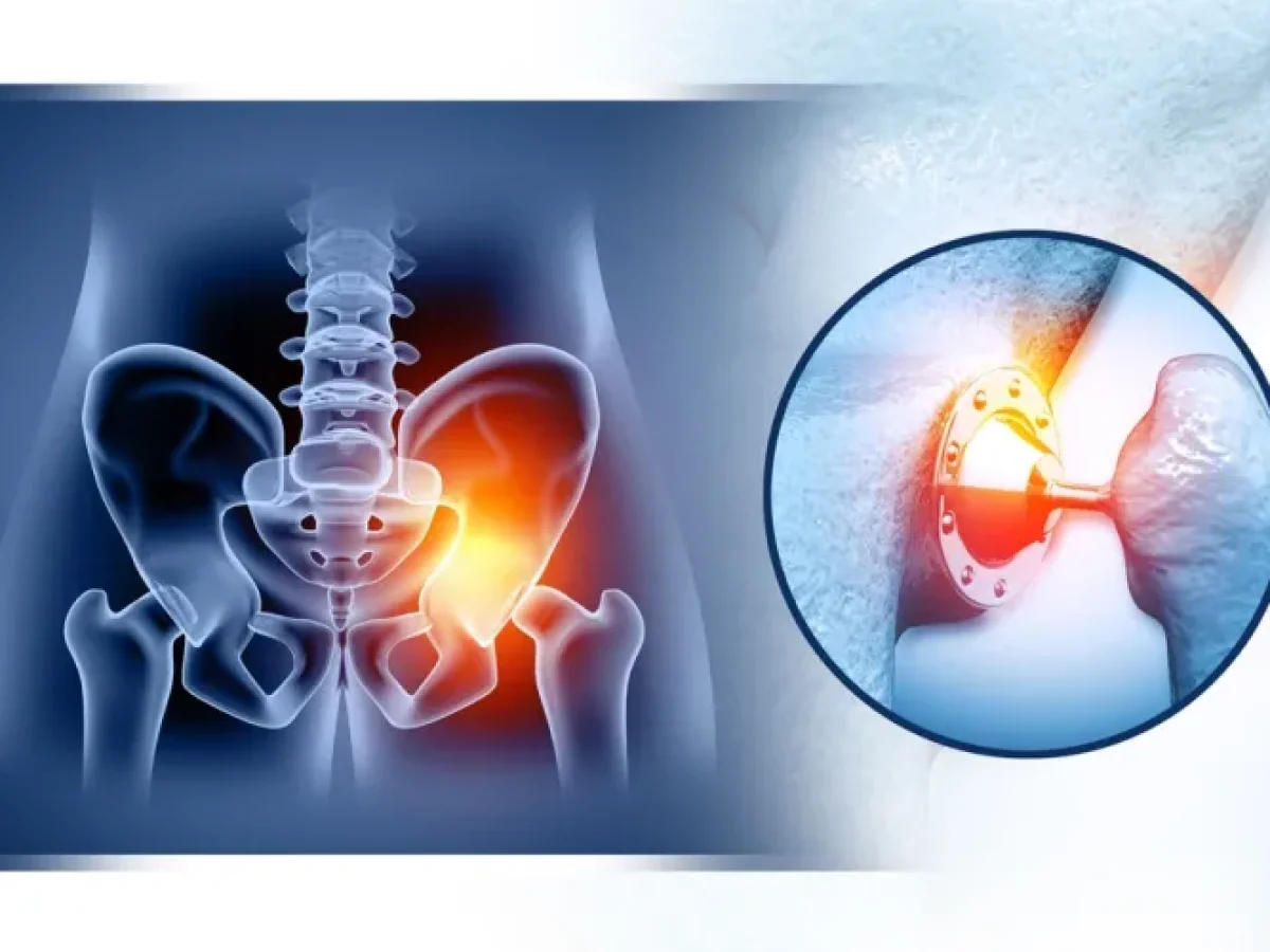 مخاطر عملية تغيير مفصل الحوض 2025