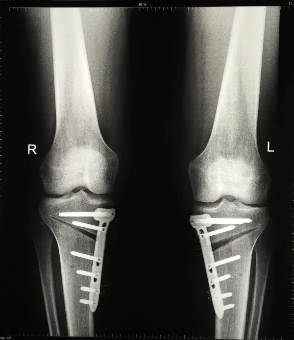 متى يستدعي القلق عند اكتشاف تقوس الساقين؟