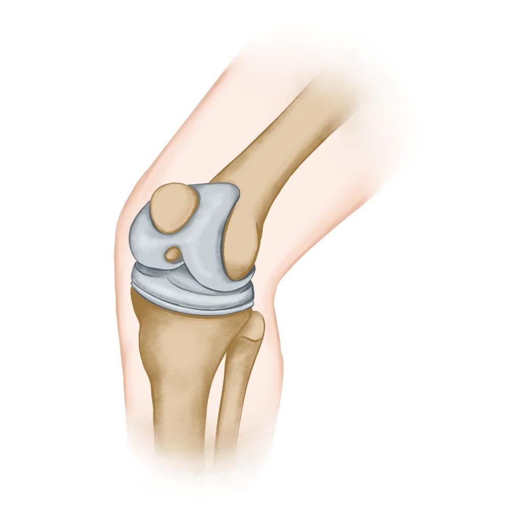ما هي عملية تغير مفصل الركبة؟