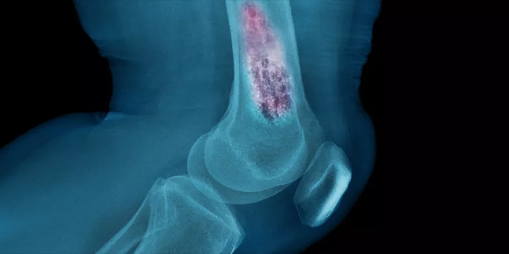 ما هي الأسباب الأخرى لألم العظام؟