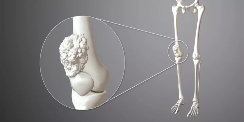 أورام العظام الحميدة