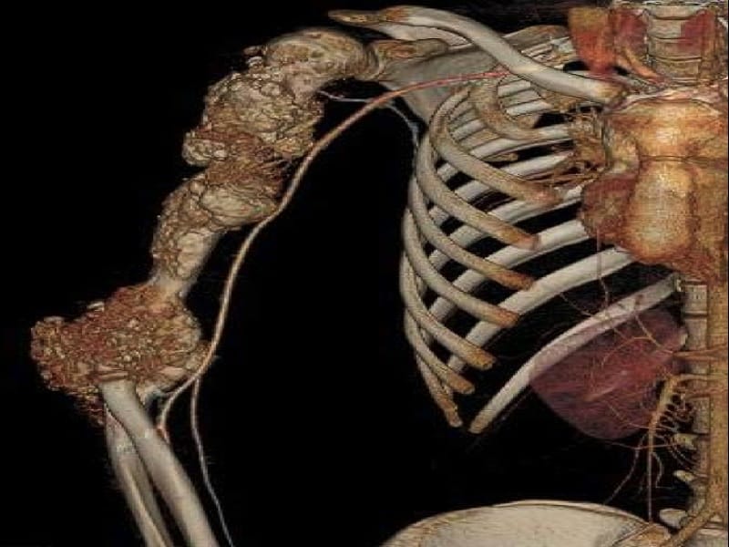 طرق تشخيص ورم العظام 