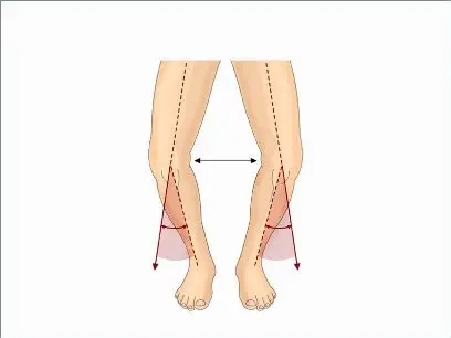 ما الذي يسبب تقوس الساقين المرضي؟