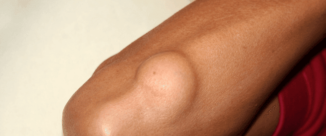 أورام العظام الحميدة