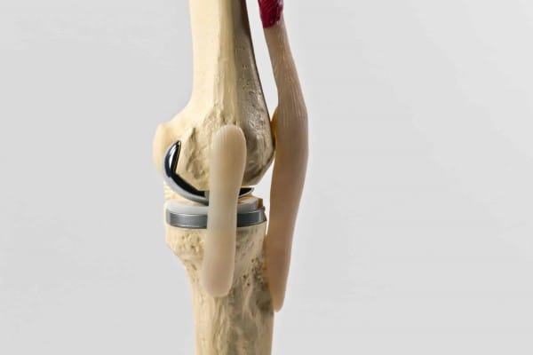 المضاعفات المحتملة بعد عملية تغير مفصل الركبة