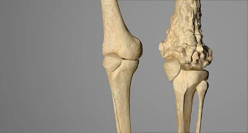 ما هو ورم العظام؟ 