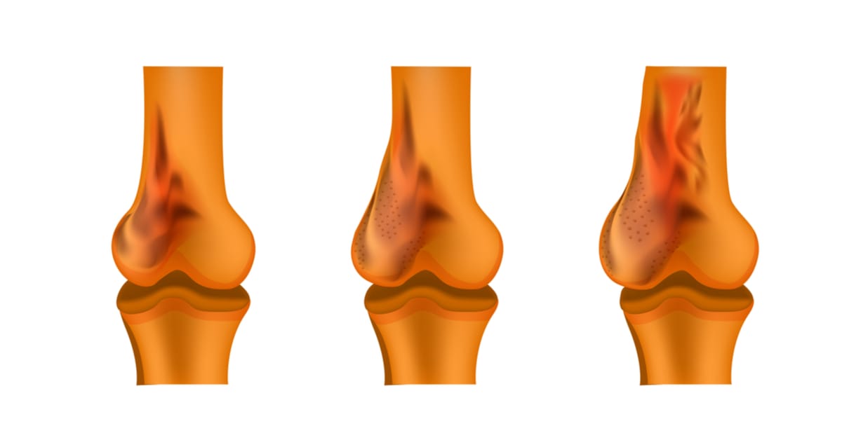 أعراض ورم العظام