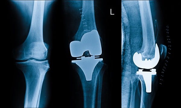 أنواع عمليات تغيير مفصل الركبة