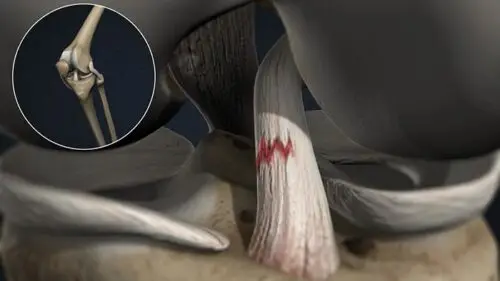 أعراض قطع الرباط الصليبي