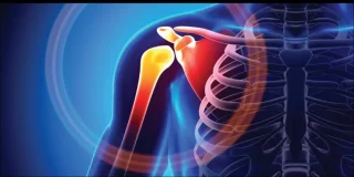 علاج قطع الأوتار الدوارة بالكتف