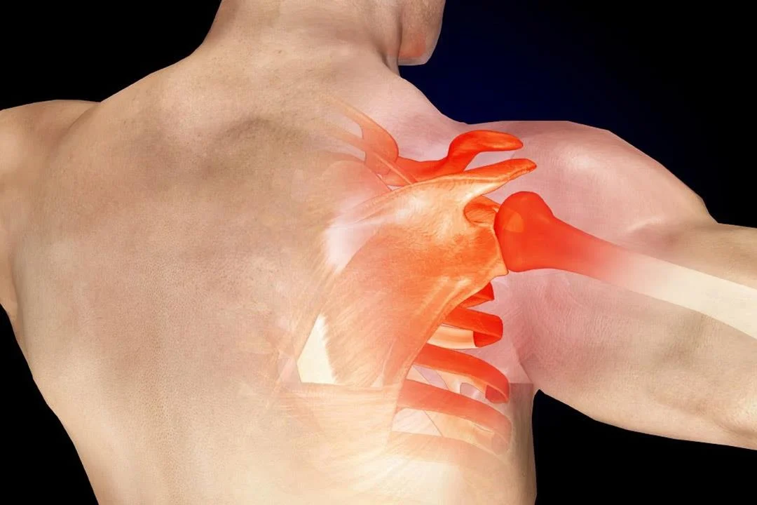 علاج قطع الأوتار الدوارة بالكتف