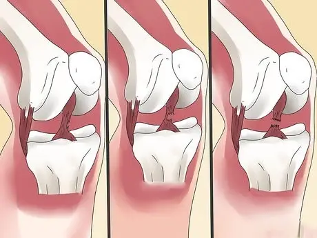 أسباب تمزق الرباط الصليبي.. أعرف التفاصيل للمخاطر والوقاية