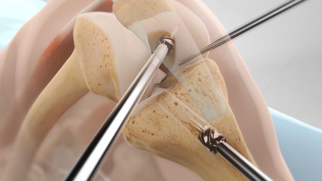 عملية الرباط الصليبي بالمنظار