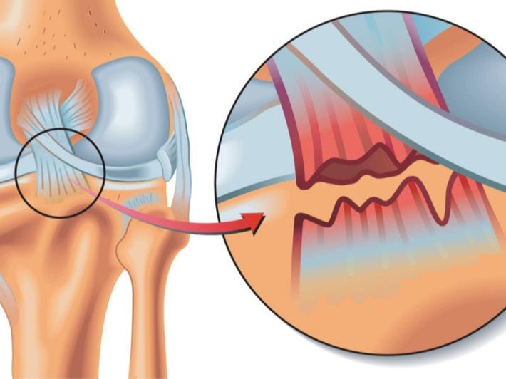أسباب إصابة الرباط الصليبي