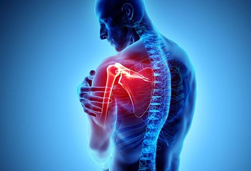 متي استطيع العودة الي العمل بعد عملية إصلاح أوتار الكتف