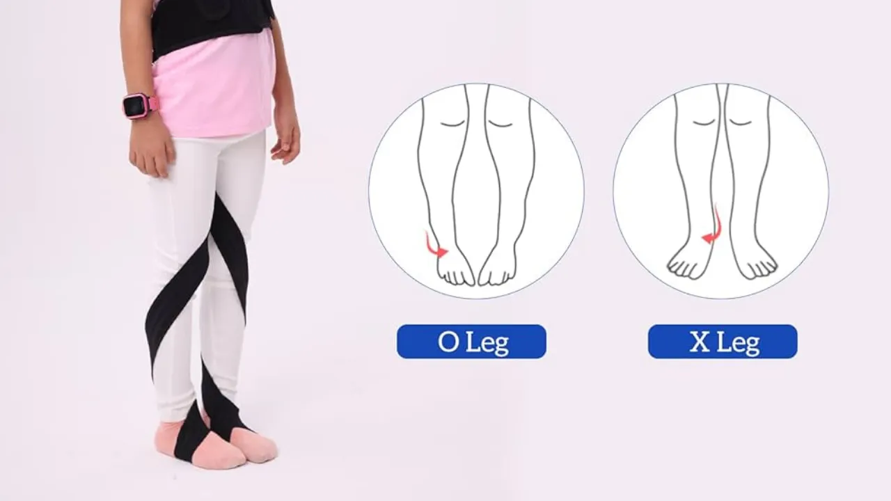 علاج تقوس الساقين
