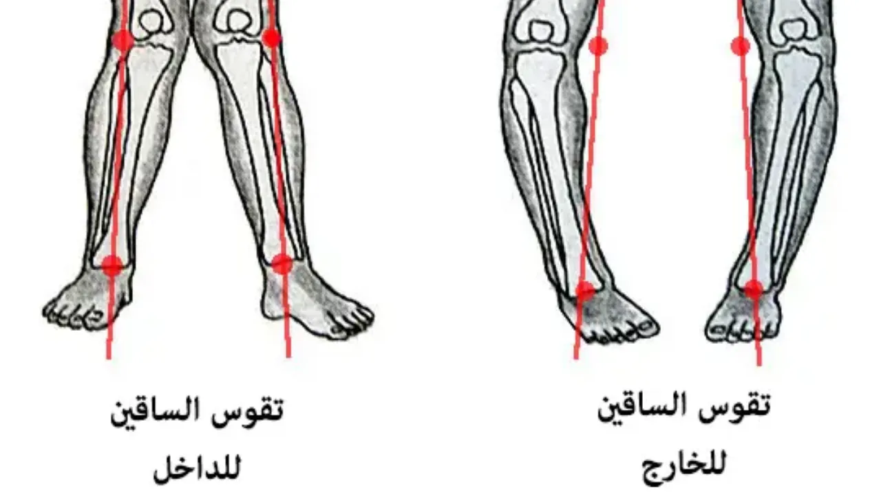 علاج تقوس الساقين