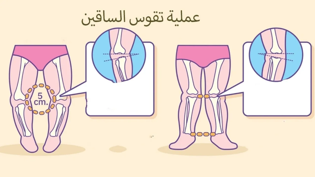 علاج تقوس الساقين