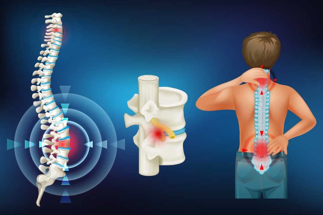 عملية توسيع القناة العصبية